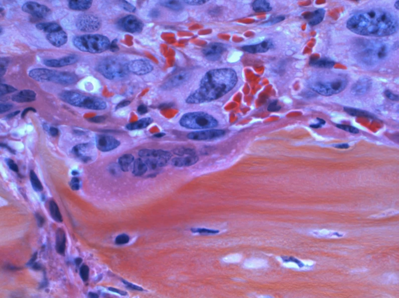Cancer Spreading to the Bone